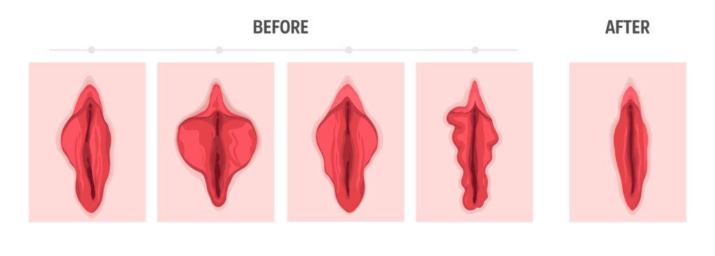 What Causes Large Labia and What You Can Do About It