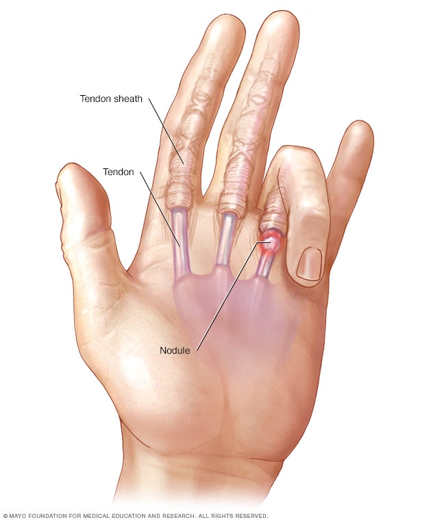 10 Causes of Stiff Fingers