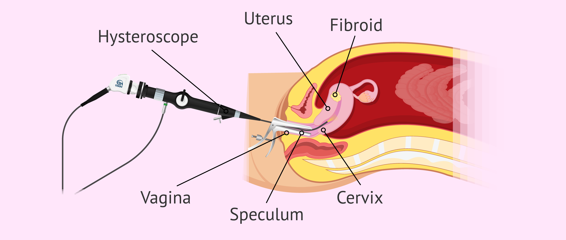 Hysteroscopy