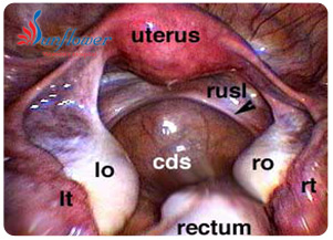 Endoscope Uterus