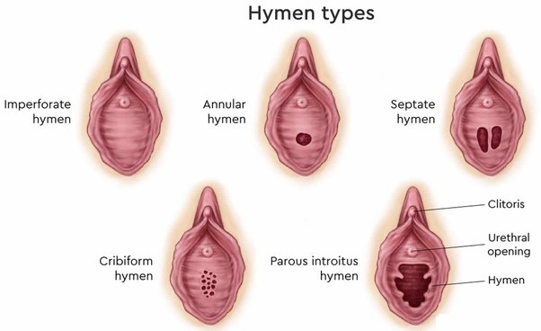 Does It Hurt When Your Hymen Breaks?