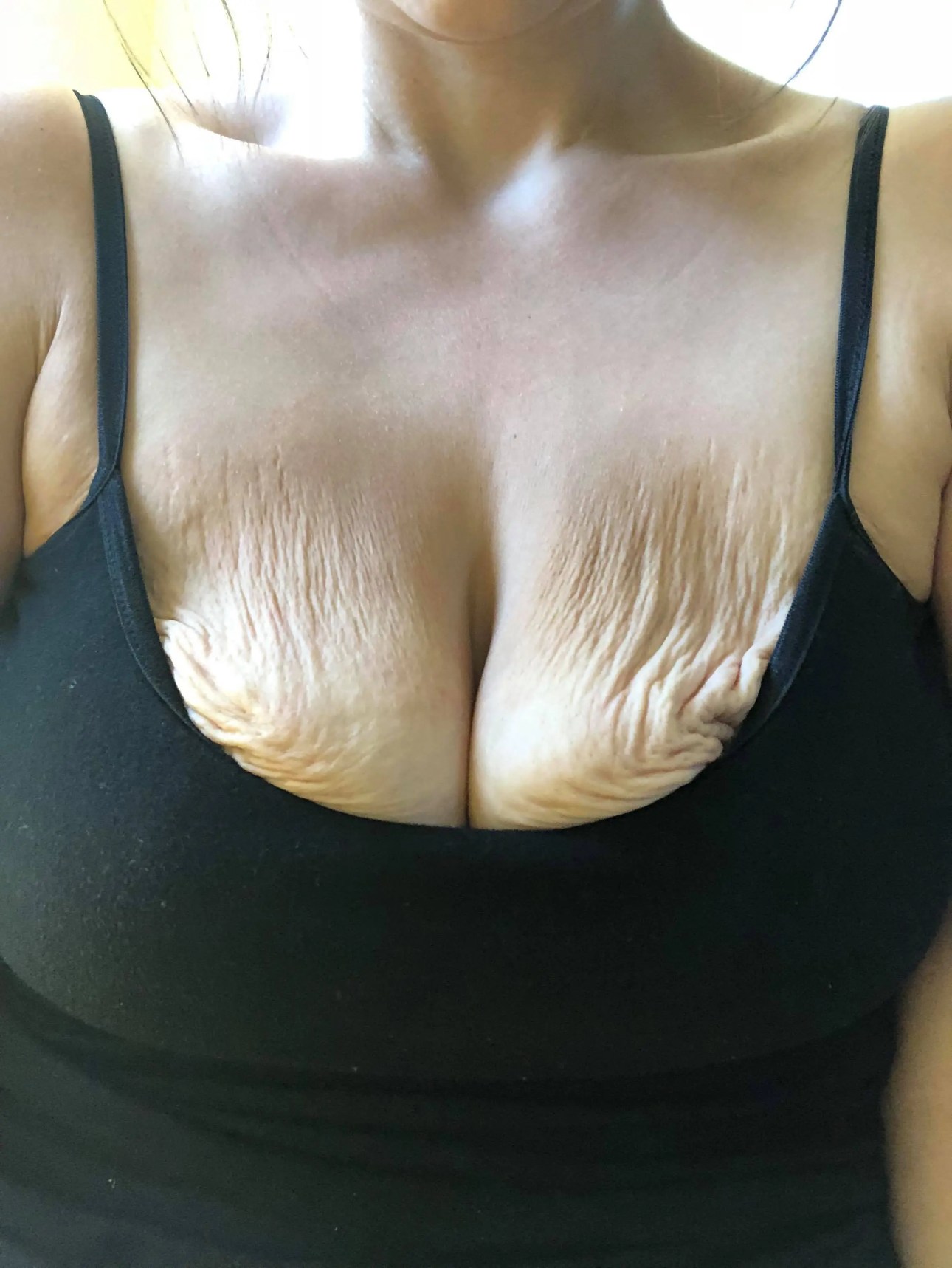 Why do breasts sag after weight loss and what can I do?