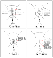 Female genital mutation