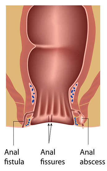 Who gets pinworm infection?