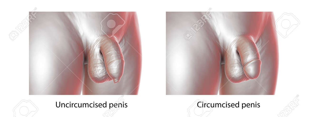 What are the health benefits and safety concerns associated with circumcision?