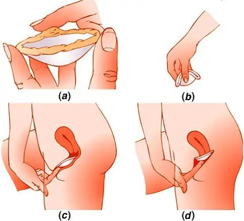 Kondom Wanita (Diafragma): Ketahui Cara Pakai, Kelebihan, dan Kekurangannya