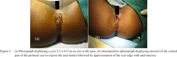 Anal dilatation in children