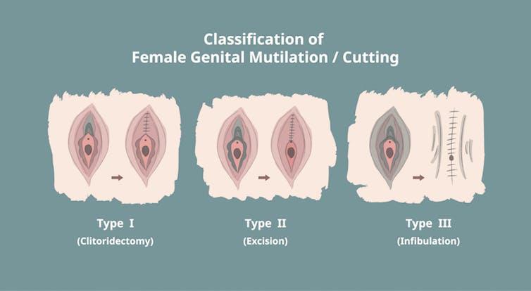 Circumcision female