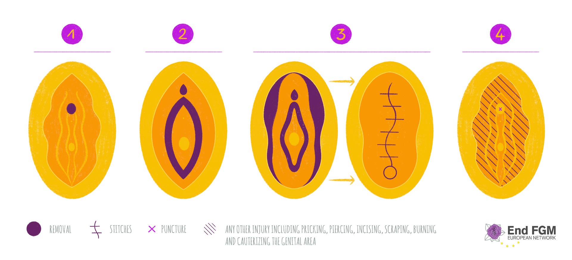 What is FGM?