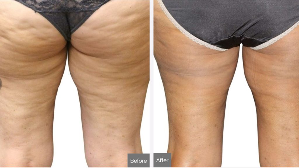 Who is at risk of cellulite?