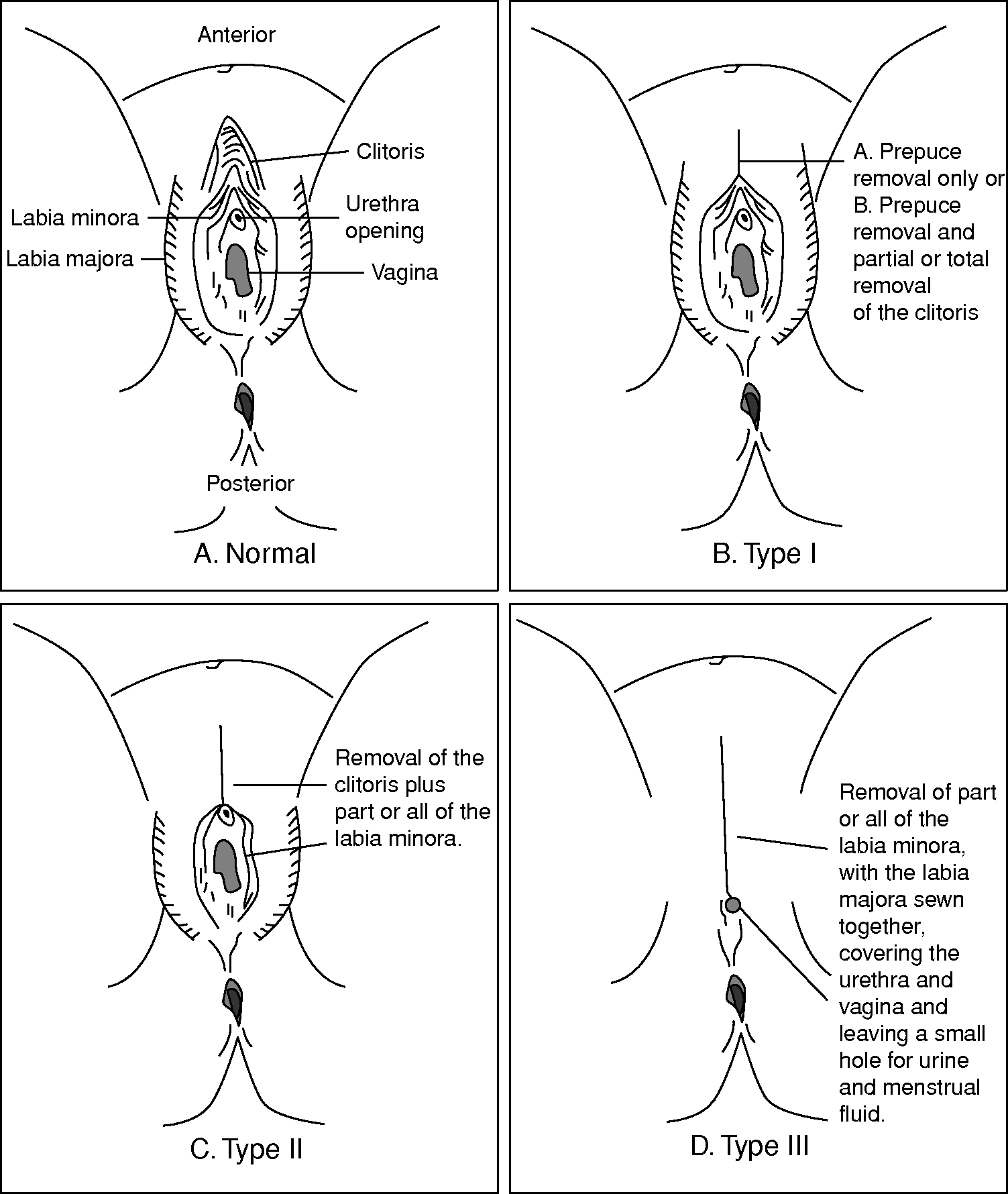 Female genital mutilation or cutting