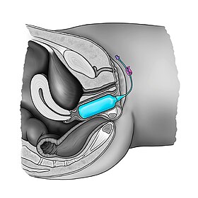 What Are Vaginal Anomalies?